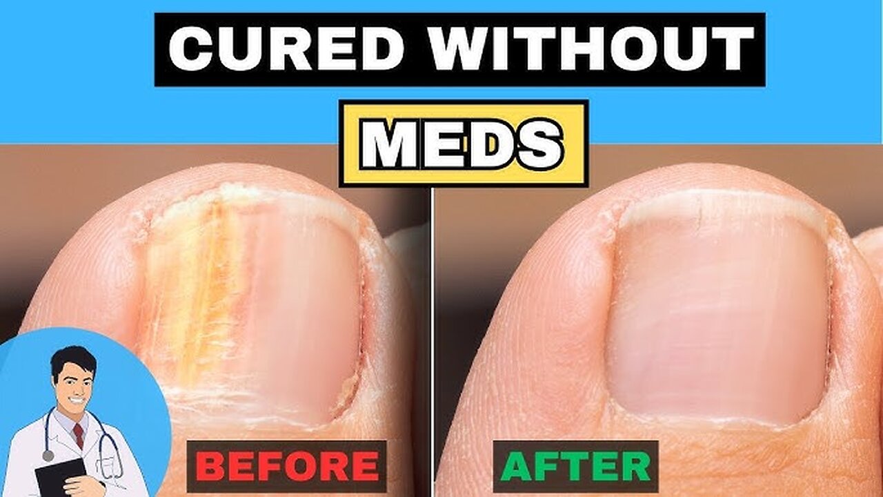 Nail Fungus Unveiled: Causes, Symptoms, and Natural Treatments