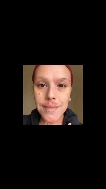 HERPES CURE. Get rid of herpes WITH MY HERBAL MEDICINE #herpes drewicuringherprs@gmail.com