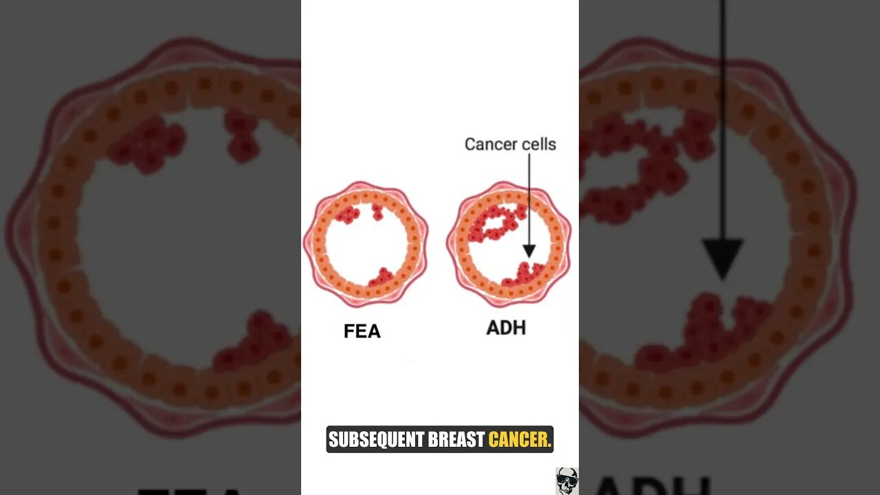 Intro to Breast Cancer