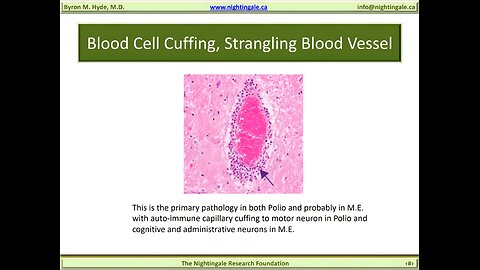 Blood Cell "Vascular" Cuffing, Strangling Blood Vessel - Byron Hyde, MD