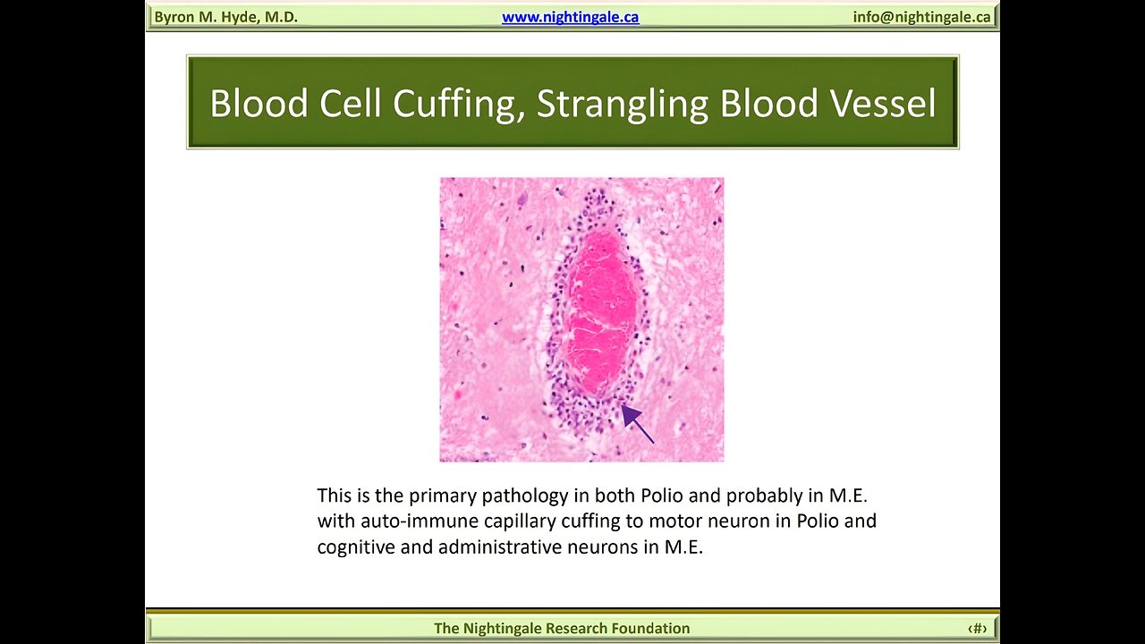 Blood Cell "Vascular" Cuffing, Strangling Blood Vessel - Byron Hyde, MD