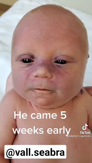 Baby with black eyes born to vaccinated parents. Does it look like a normal baby to you?