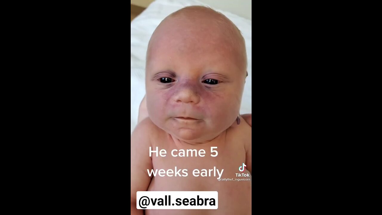 Baby with black eyes born to vaccinated parents. Does it look like a normal baby to you?