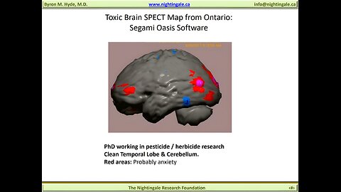 How do you test for "Myalgic Encephalomyelitis (M.E.)"? - Byron Hyde, MD