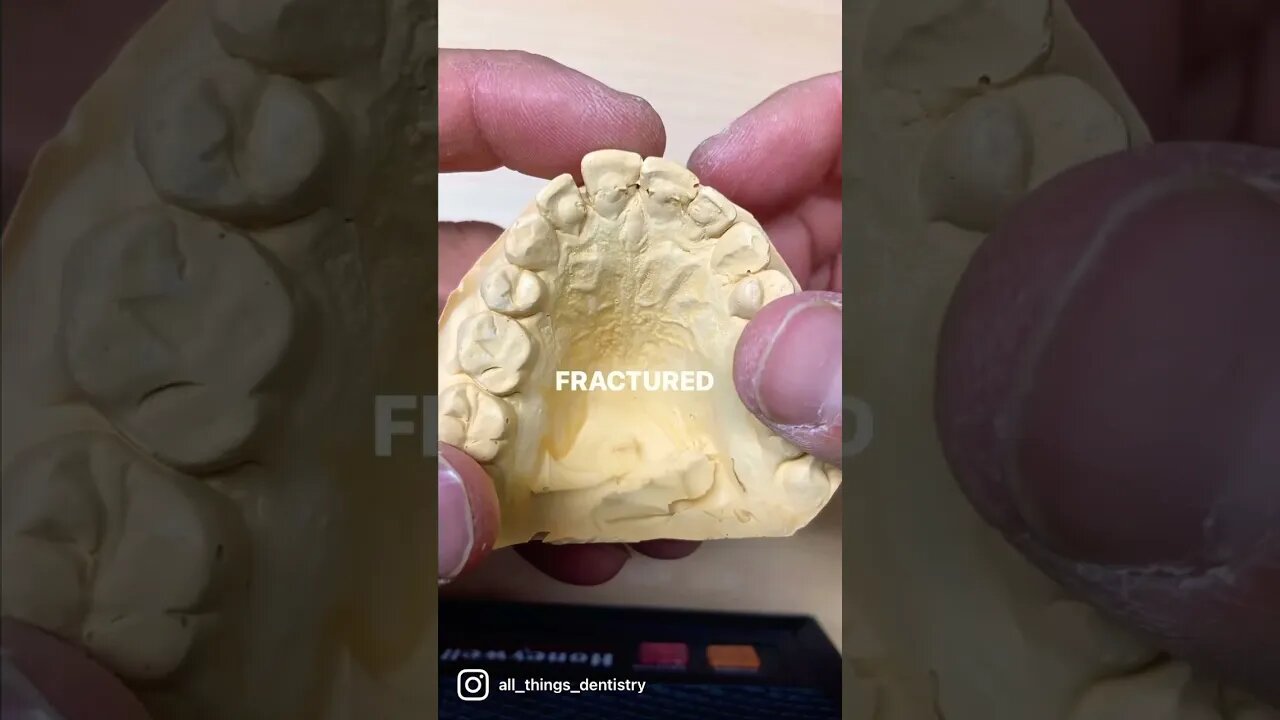 Fractured Lingual Retainers