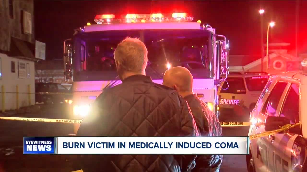 Burn victim in medically induced coma