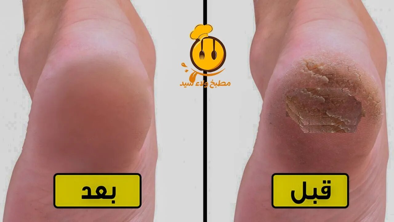 ازالة الكعوب المتشققة والحصول علي اقدام بيضاء وناصعة