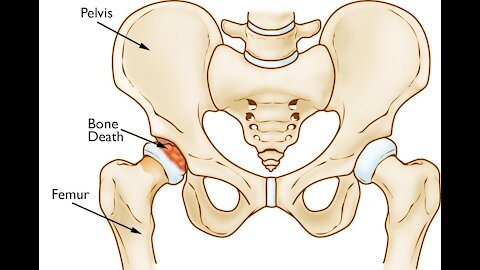 Hips Don't Lie: HHO "Browns Gas" report after 6 days of tablets