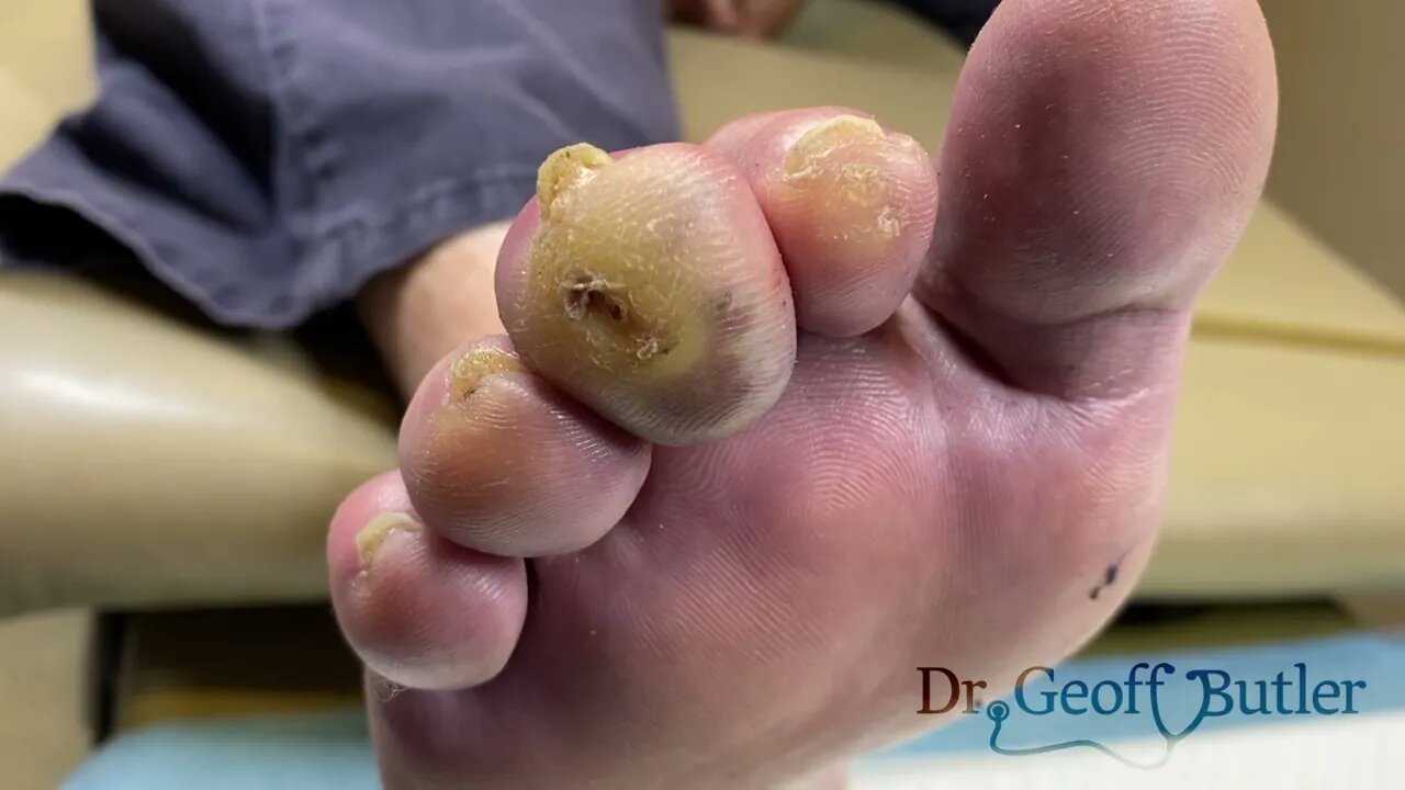 Drainage of a infected pressure ulcer on the toe (PART 1)