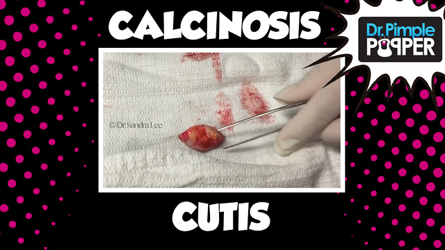 Two "Cysts" Calcinosis Cutis