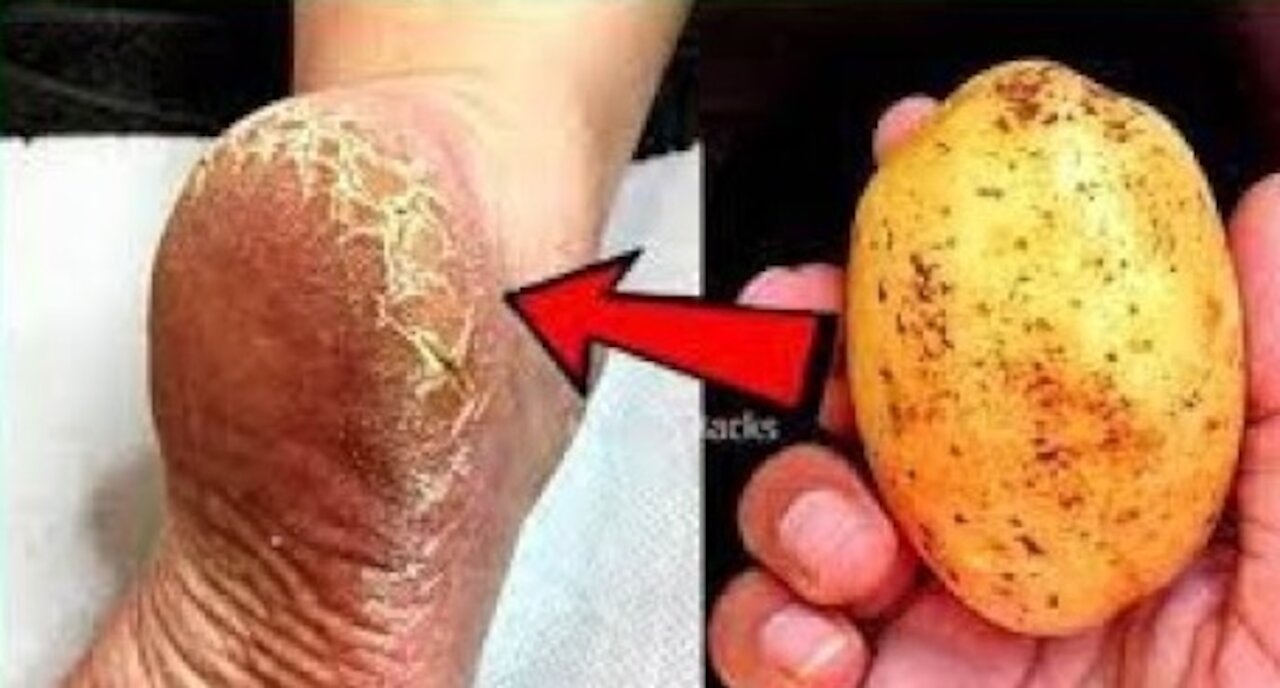 You Can Eliminate Cracked Heels And Get White And Smooth Feet A Magic Remedy