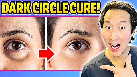 How to Get Rid of Dark Circles of Undereyes!