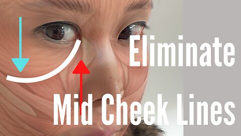 Eliminate Mid Cheek Lines