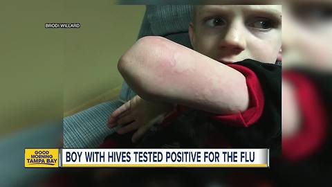 Mother warns parents after son with hives, no flu symptoms, tests positive for influenza