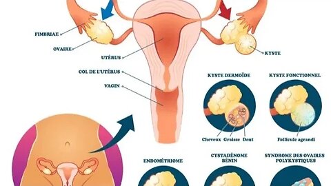 kisa ki kis nan ovaire an franse (kyste ovarien)