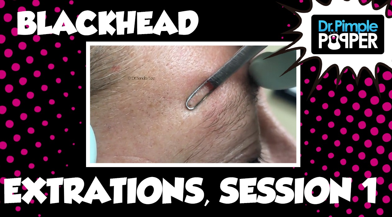 Blackheads Session One, Pre Prep