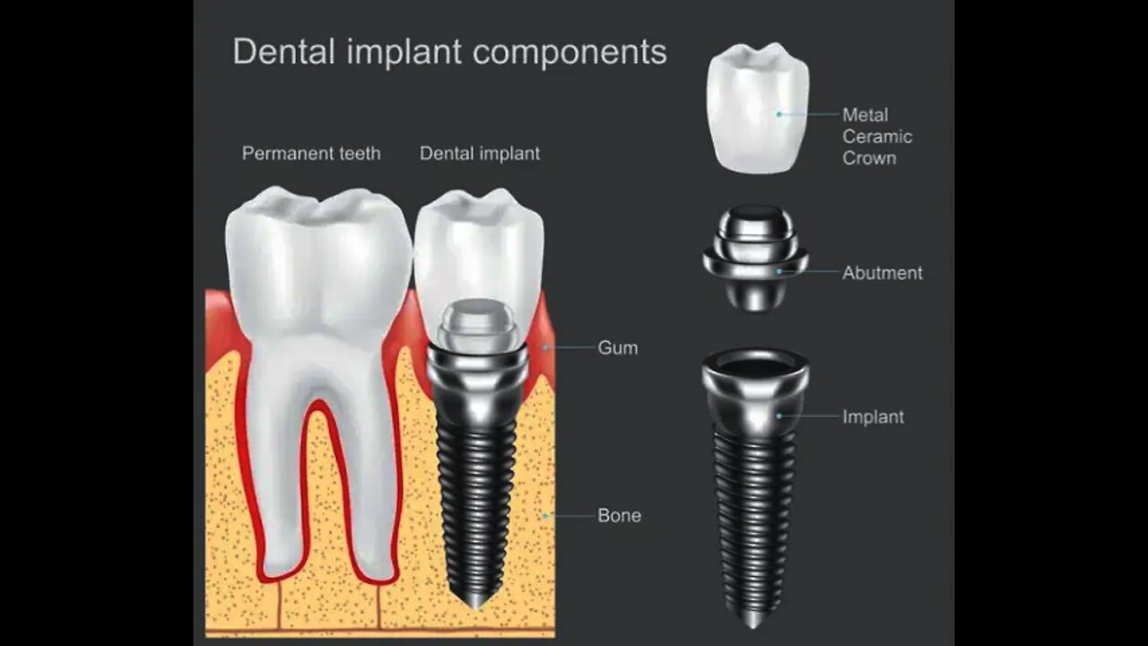 Dental Implant Procedure