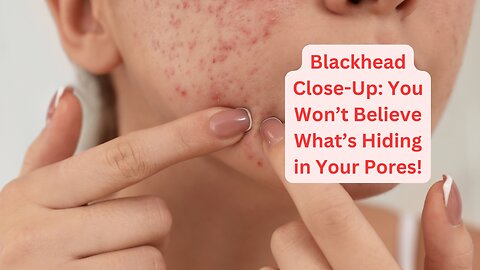 Blackhead Close-Up: You Won’t Believe What’s Hiding in Your Pores!