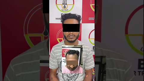 8 Month Hair Transplant Result