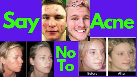 Have You Seen Mike Walden's new holistic acne System yet? It's called "Acne No More"