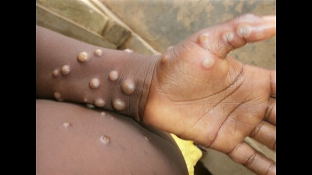 NWO: Dr. Martin says that there is NO monkeypox epidemic!