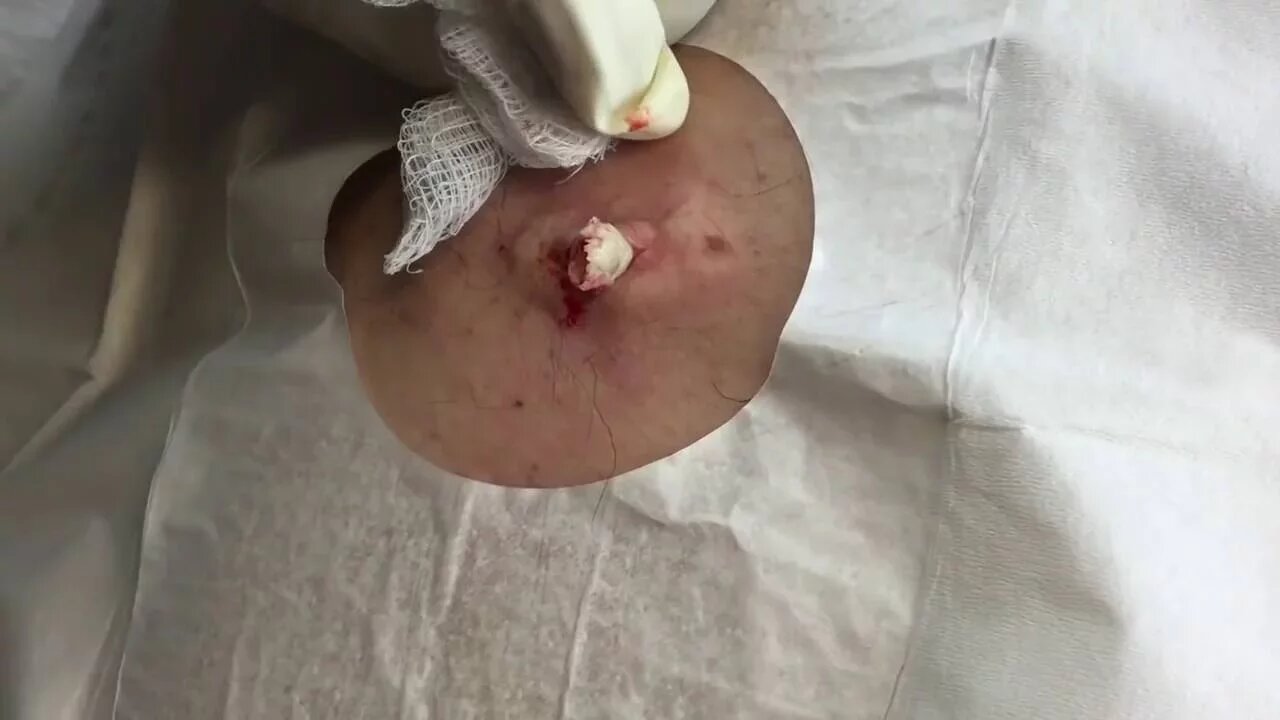 Removal of Epidermal Cyst