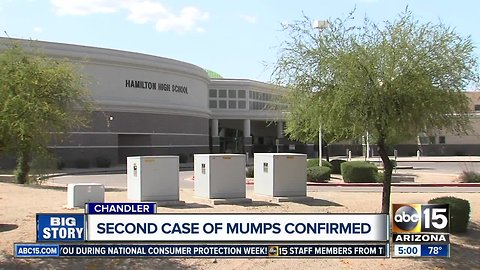 Second case of mumps in Valley confirmed