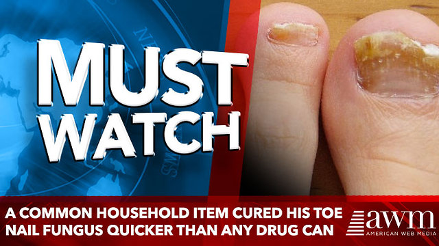 A Common Household Item Cured His Toe Nail Fungus Quicker Than Any Drug Can