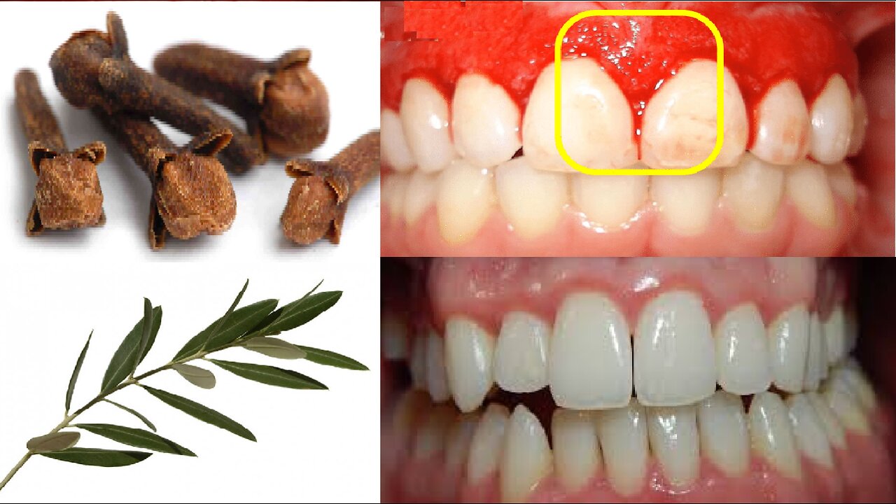 Best Natural Remedy for Inflamed Gums Say Goodbye to Bleeding Gums Gingivitis and Treat It Naturally