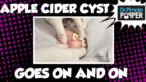 An Apple Cider Cyst That Goes On and On...