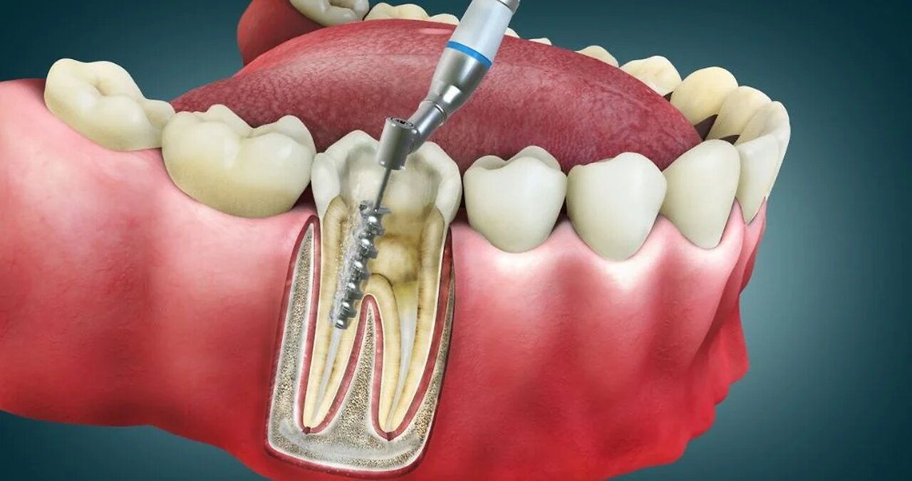 ROOT CANALS are the ROOT of your problems