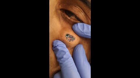 blackhead