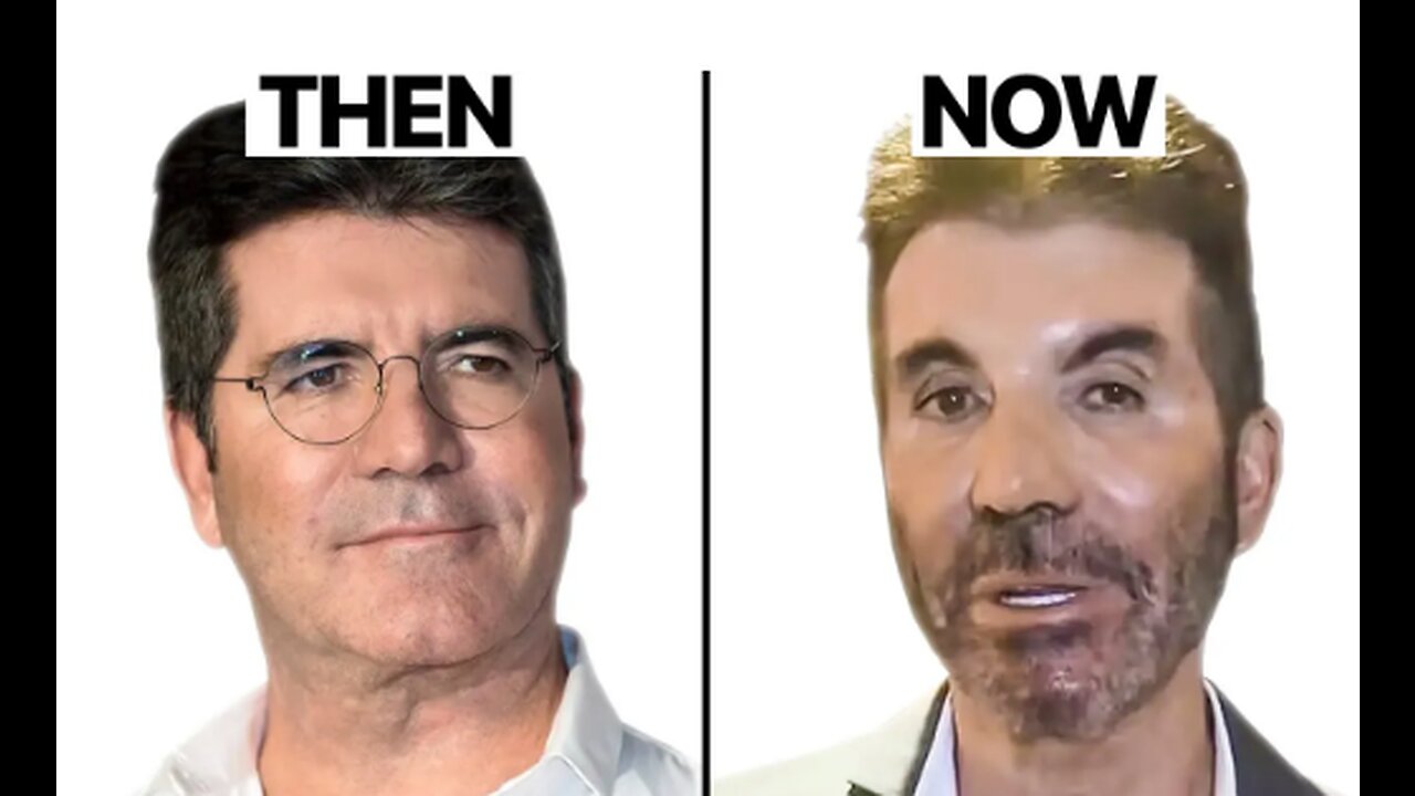 Simon Cowell NEW FACE | Plastic Surgery Analysis