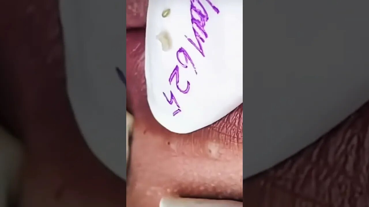 Bottom Lips Blackhead Removal PART 1