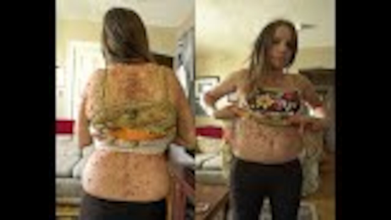 Mom Covered In 6,000 Tumors Looks Drastically Different After Her Surgery