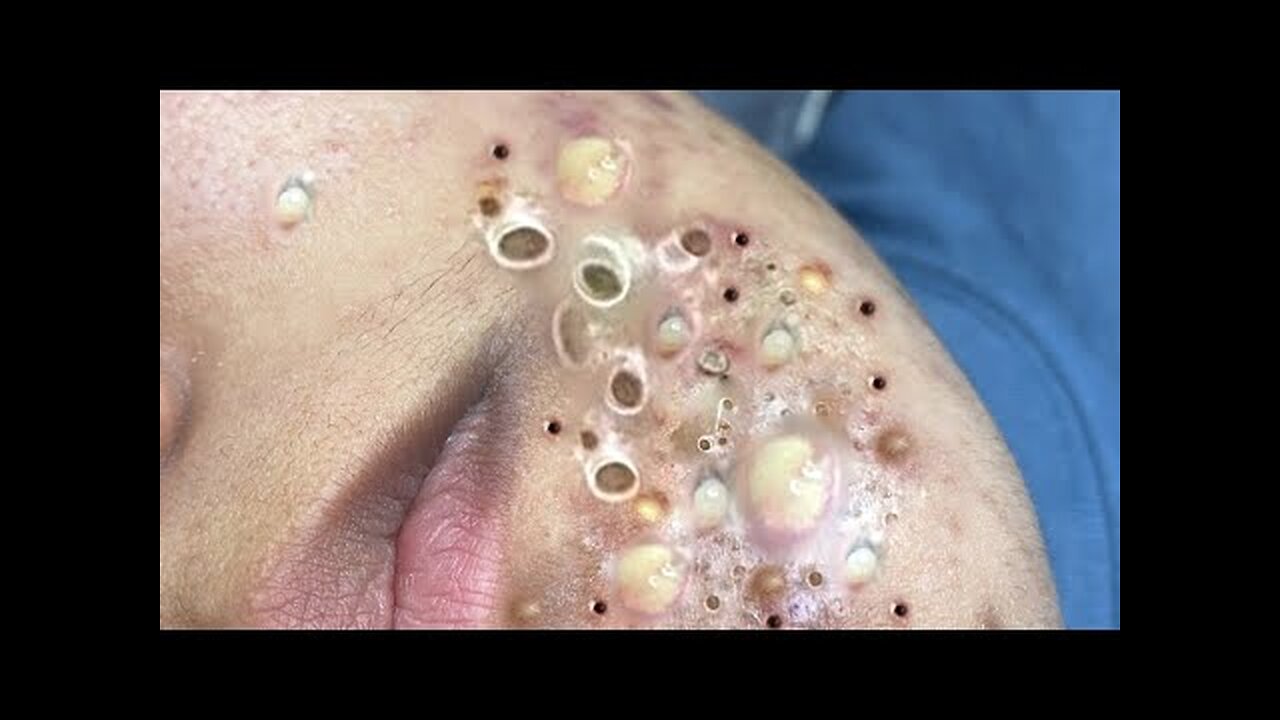 Satisfying blackhead removal, relaxing Pimple Popping 113