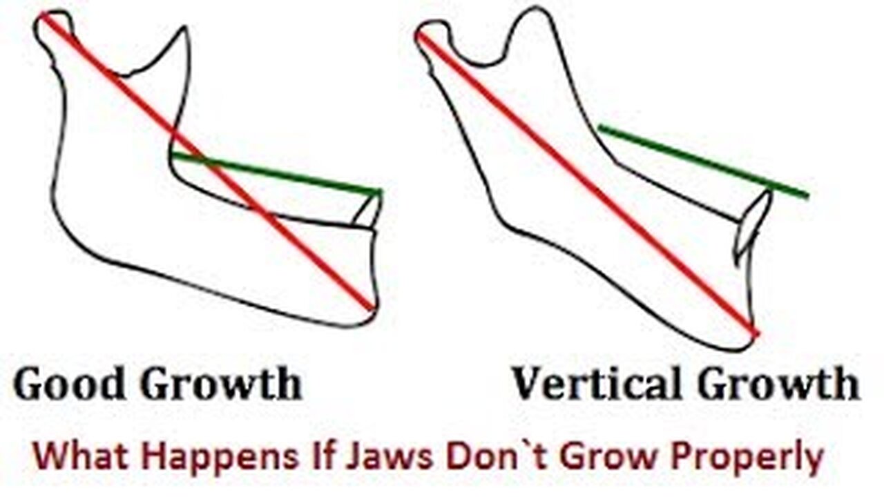 What Happens If Jaws Don`t Grow Properly