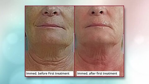 A must see! Learn about a minimally invasive treatment that stimulates the natural production of collagen