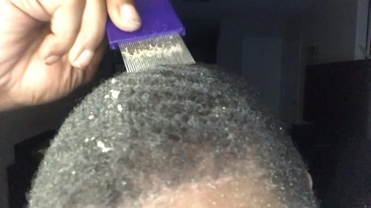 Late Night Dandruff Scratching Asmr