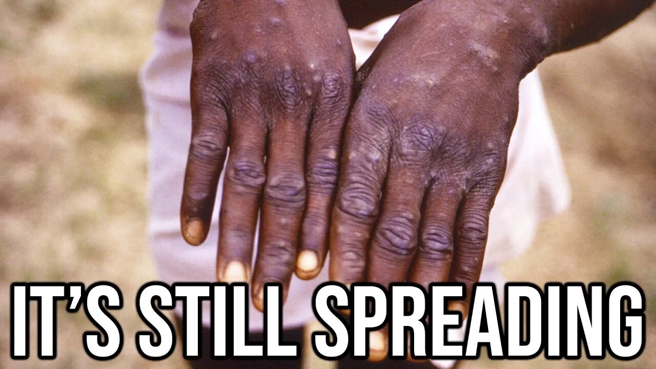 Monkeypox Is Continuing To Spread...