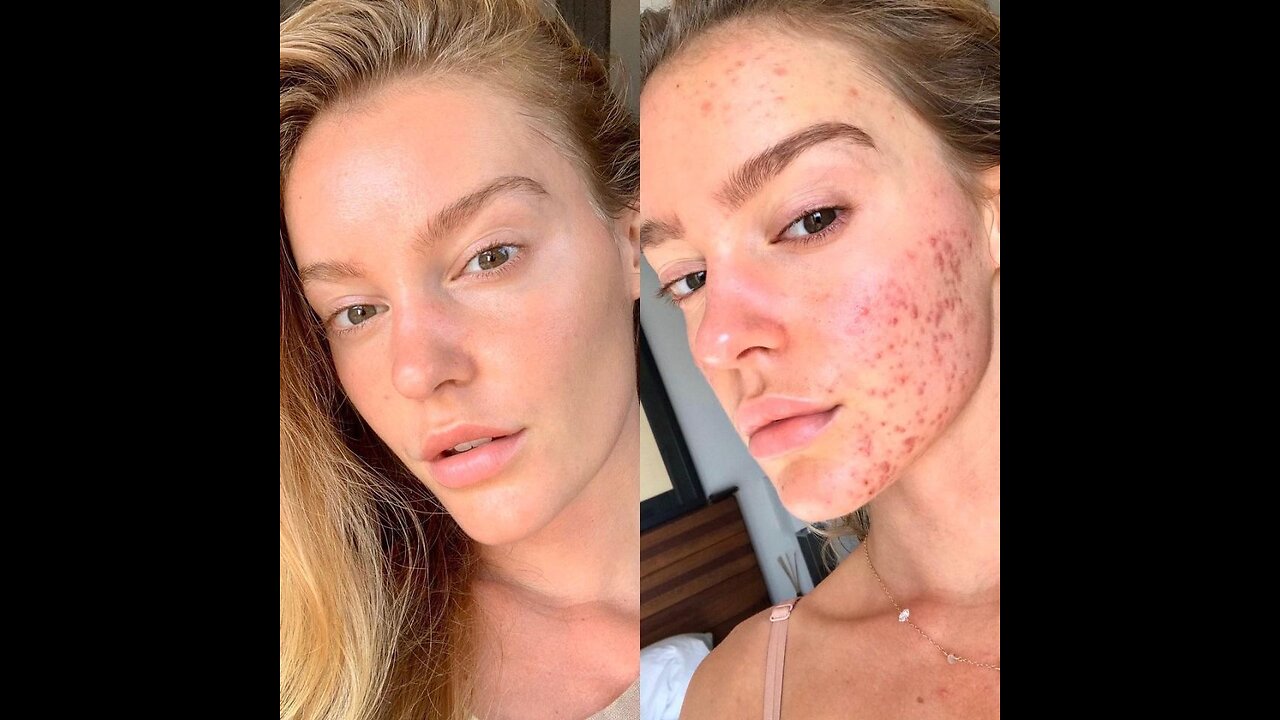 How to get rid of acne in 7 days | 100% guaranteed