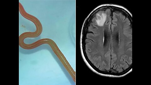 Live worm found in Australian woman's brain