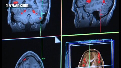 Cleveland Clinic launched first-of-its-kind brain study