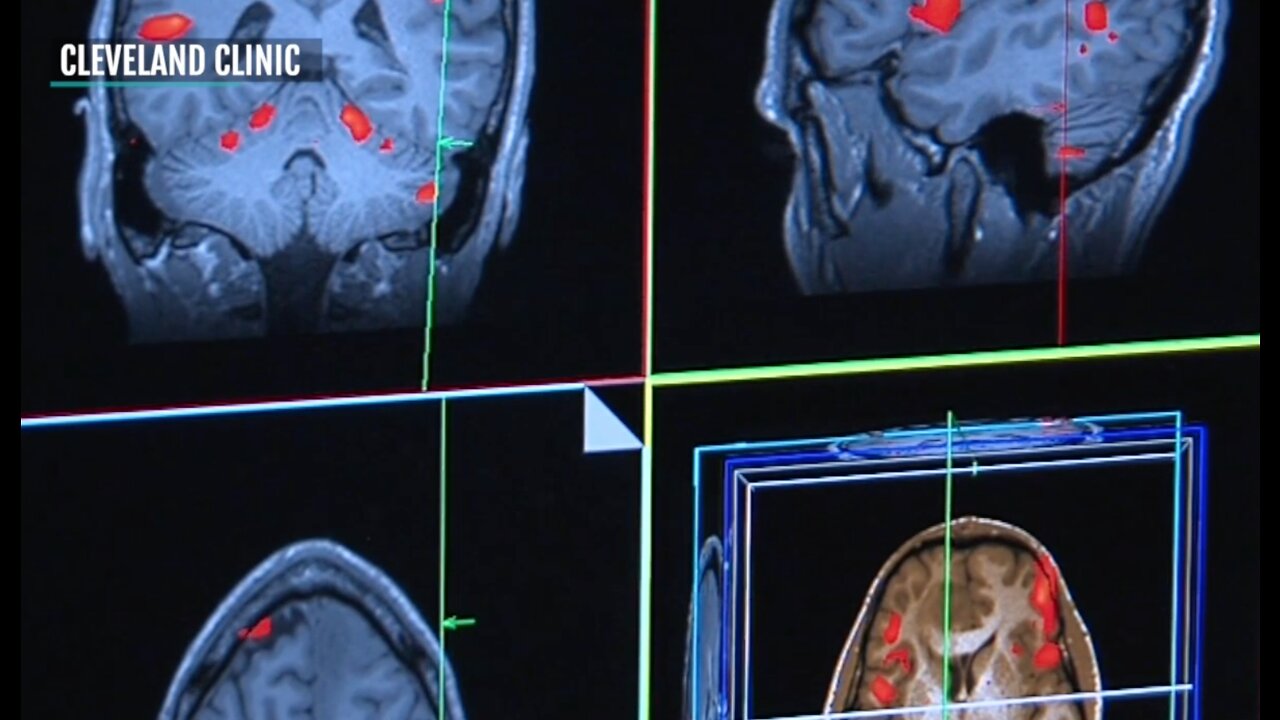 Cleveland Clinic launched first-of-its-kind brain study