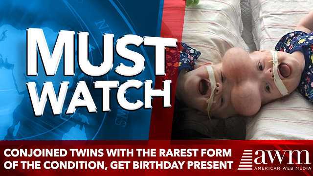 Conjoined twins with the rarest form of the condition, get Birthday Present