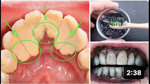 How to Remove Plaque and Tartar from Teeth at Home