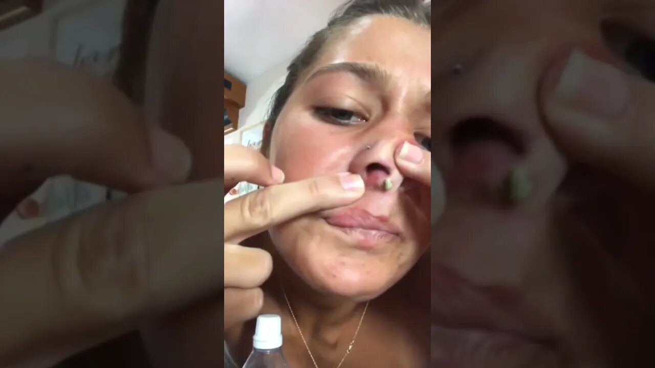 Que lugar mais inconveniente para nascer uma acne