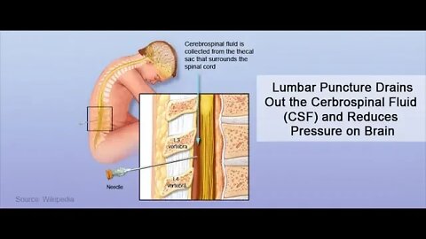 Intracranial Pressure - More than 1 Way to Get Relief!