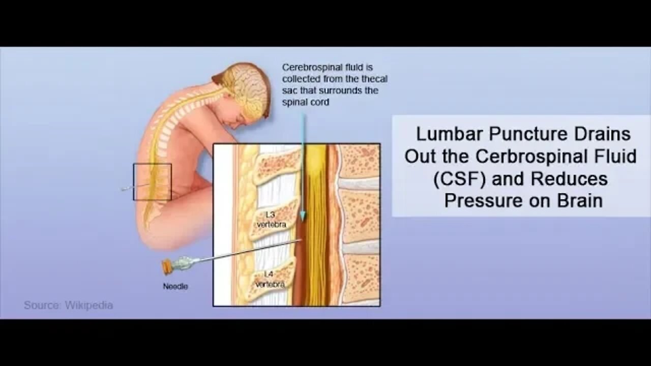 Intracranial Pressure - More than 1 Way to Get Relief!