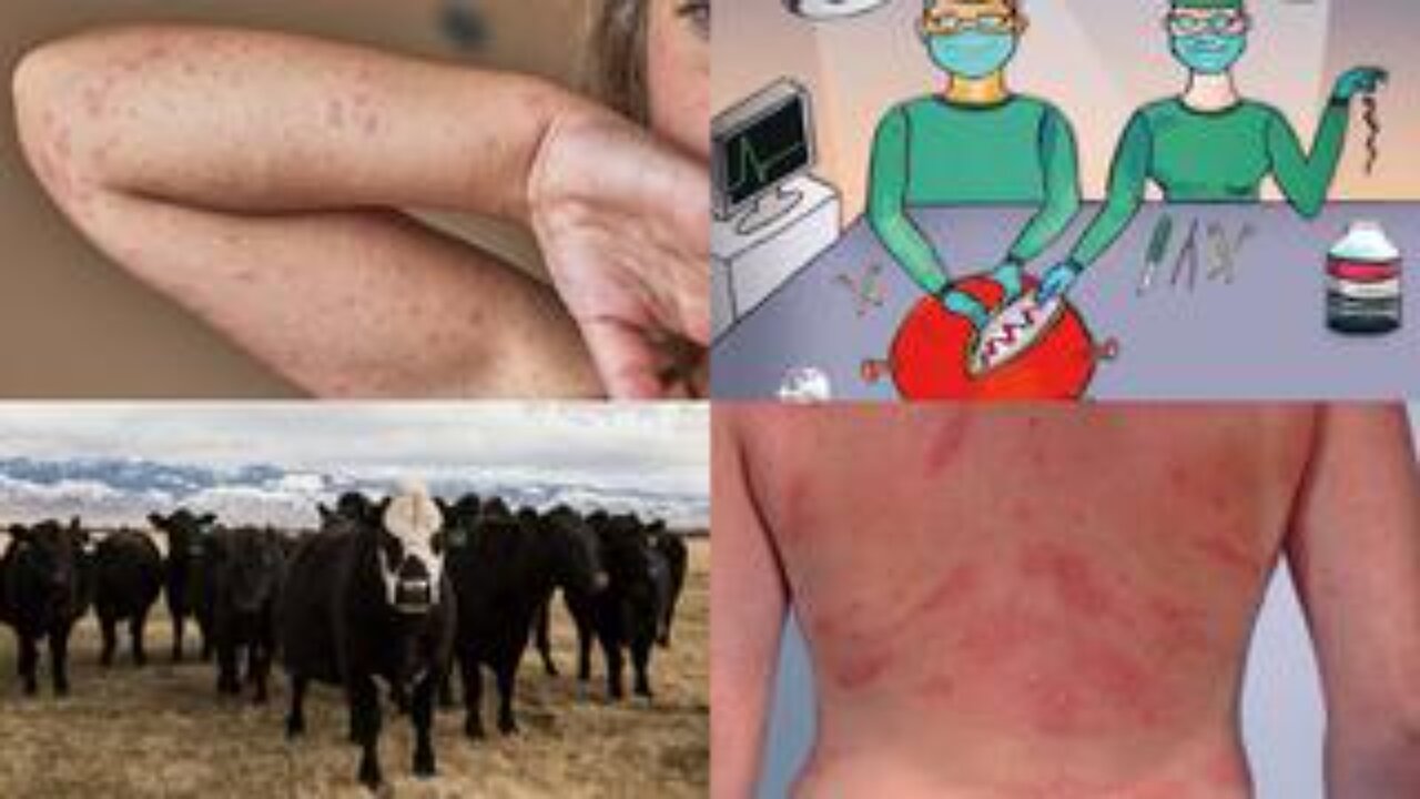 Bombshell! Covid Vaccines Contain Cow Protein That Triggers Deadly Meat Allergies!